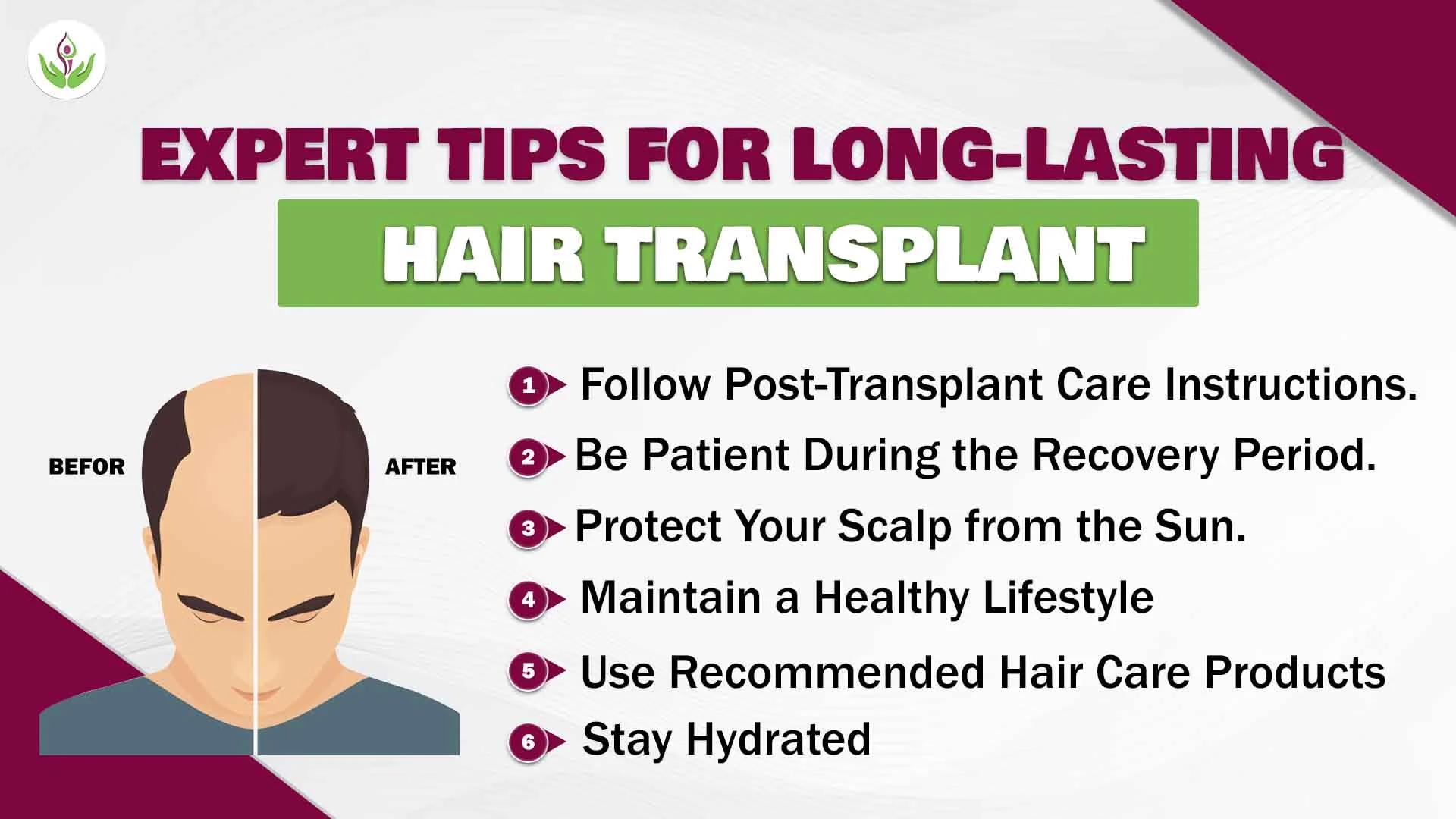  Tips for Long-Lasting Hair Transplant