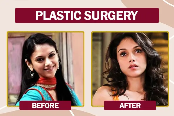 Aditi Rao Hydari Plastic surgery before and after photo