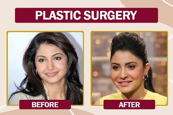 Anushka Sharma Plastic Surgery Before and After Photo