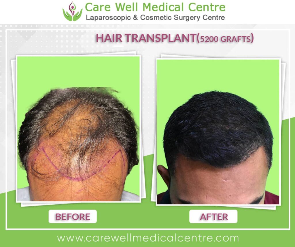 Before and after hair transplant comparison