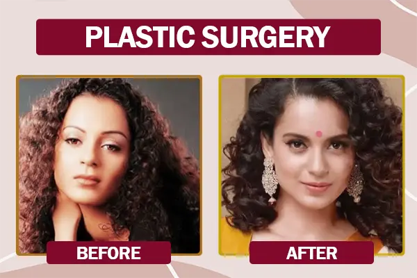 Kangana Ranaut Cosmetic Surgery Before and After Photo