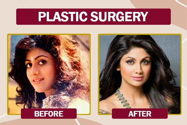 Shilpa Shetty Plastic Surgery Before and After Photo