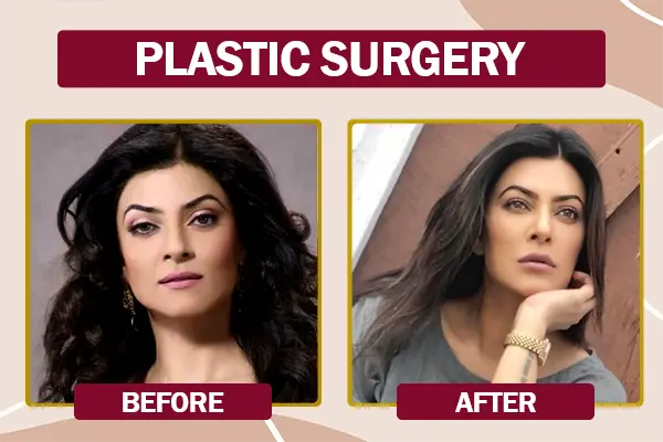 Sushmita Sen Plastic Surgery Before and After Photo