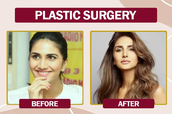 Vaani Kapoor Cosmetic Surgery Before and After Photo