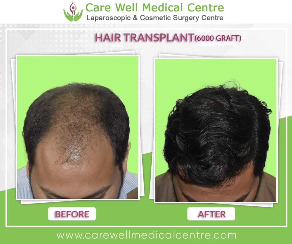 Transformation through hair transplant procedure