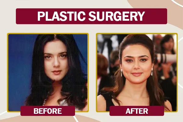 Preity Zinta Cosmetic Surgery Before and After Photo