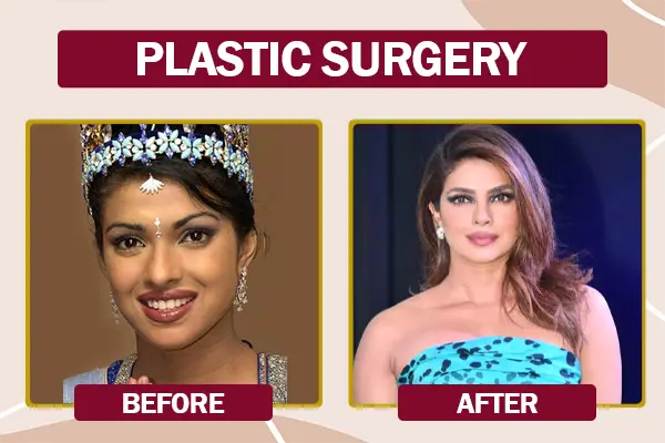 Priyanka Chopra Bollywood Actresses Plastic Surgery