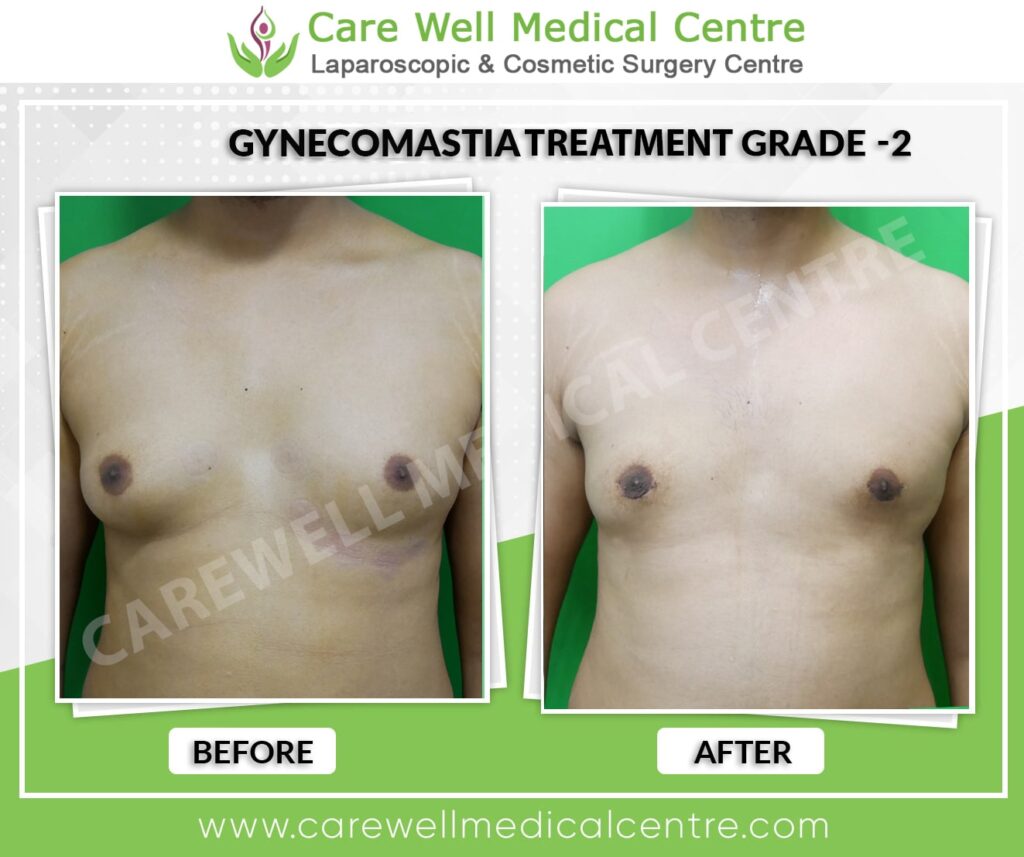 Best Gynecomastia Surgery in Delhi Before and After Results Photo