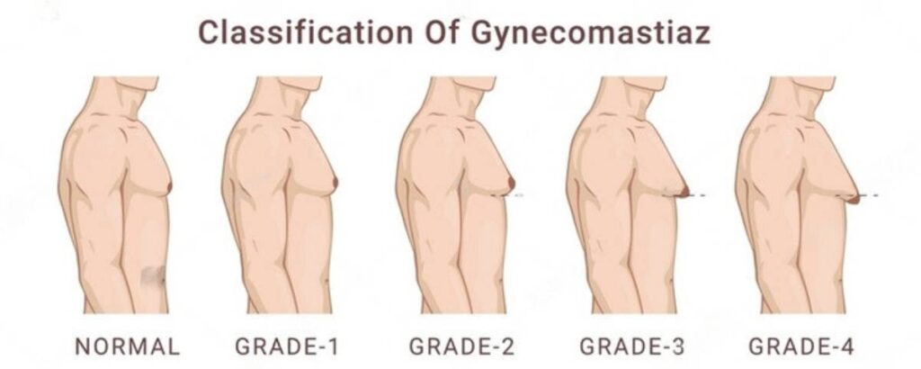 Different kinds stages of gynecomastia