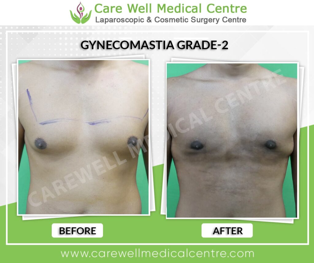 Best Gynecomastia Surgery in Delhi Before and After Results
