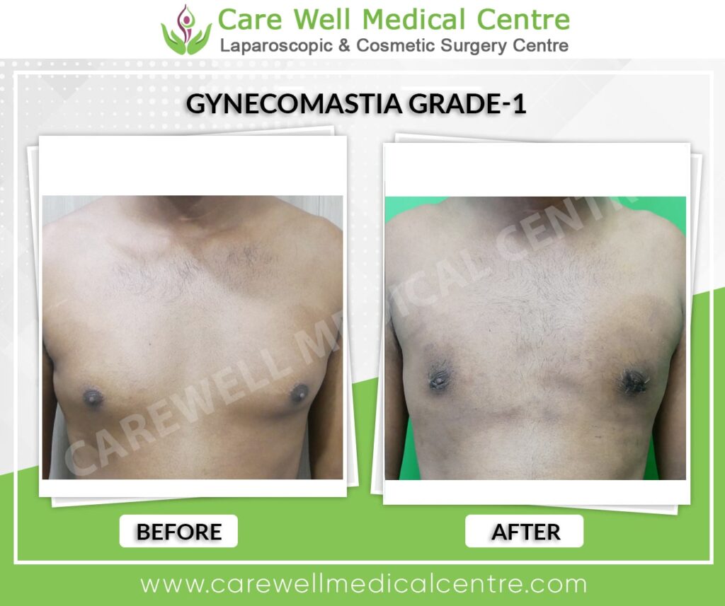 Best Gynecomastia Surgery in Delhi Before and After Result Photo