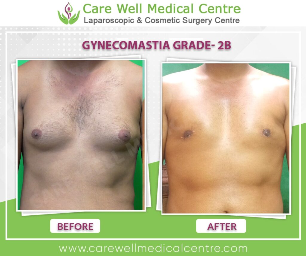 Best Gynecomastia Surgery in Delhi Before and After Results Image