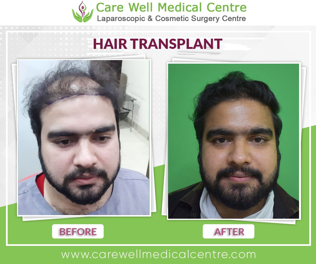 Hair Transplant in India Before and after result photo