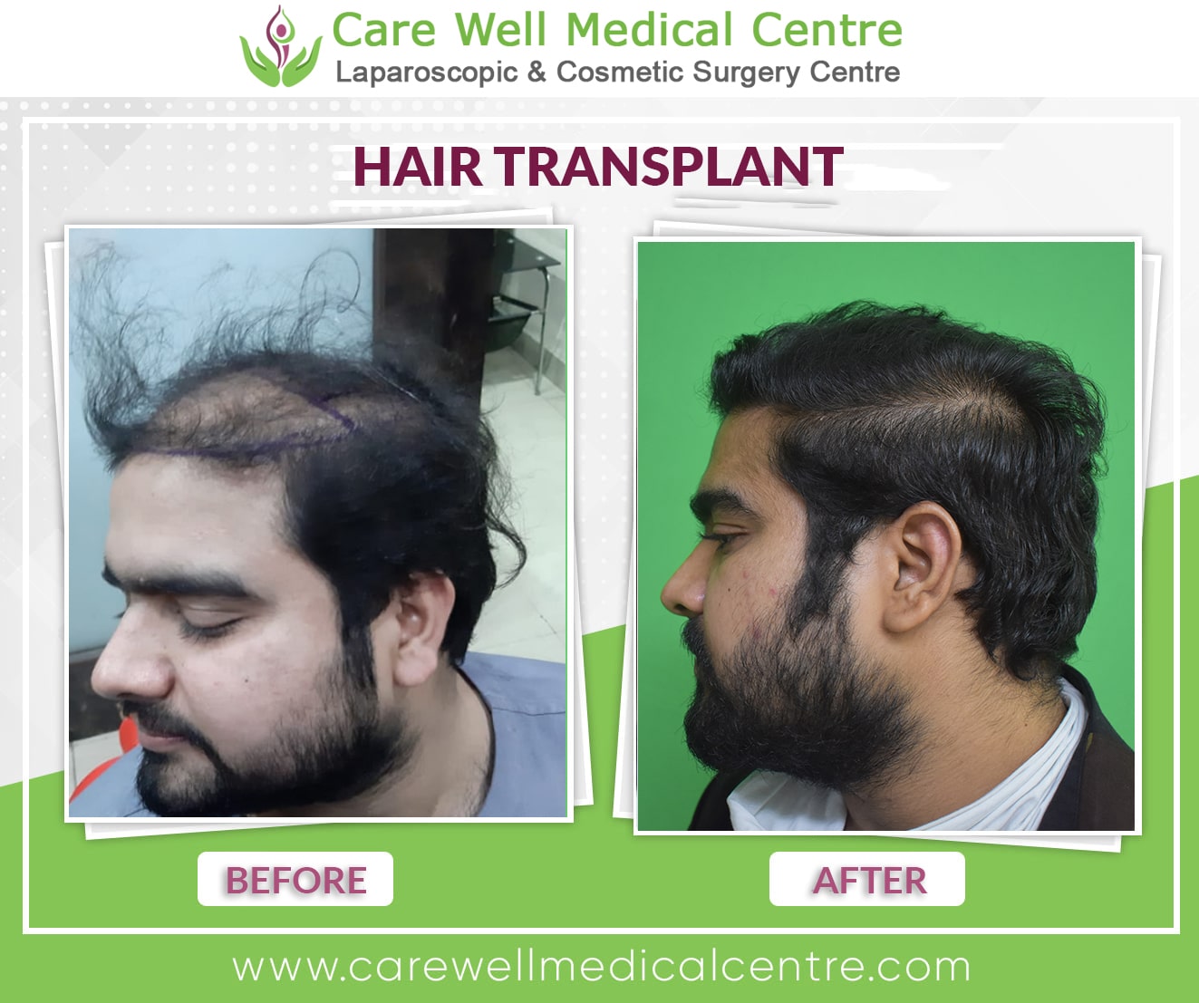 Hair Transplant in India Before and after result