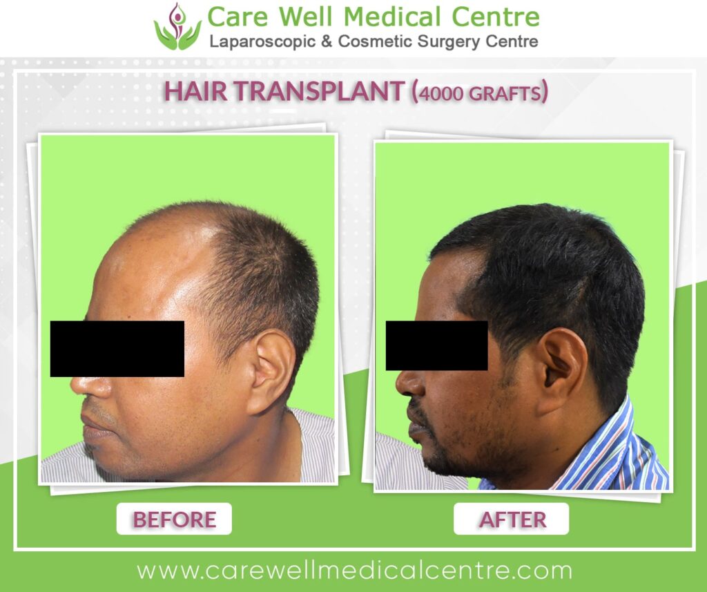hair transplant before and after result photo 4000 graft - 2