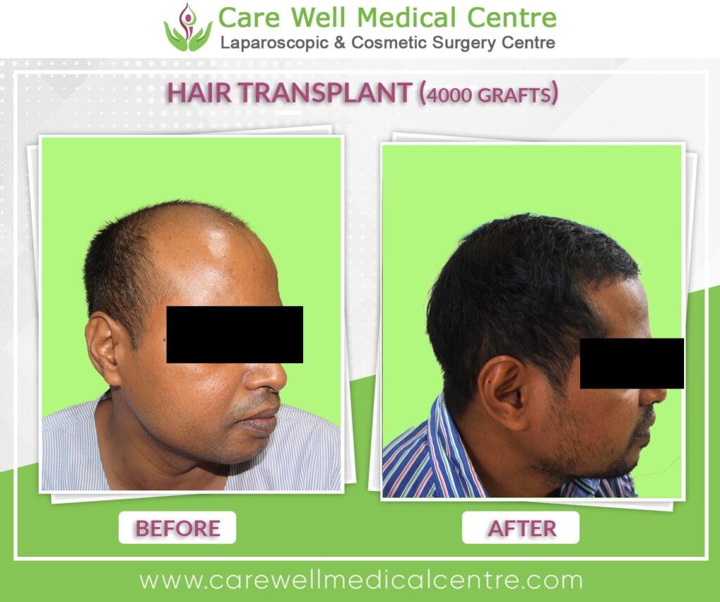 hair transplant before and after result photo 4000 graft - 1
