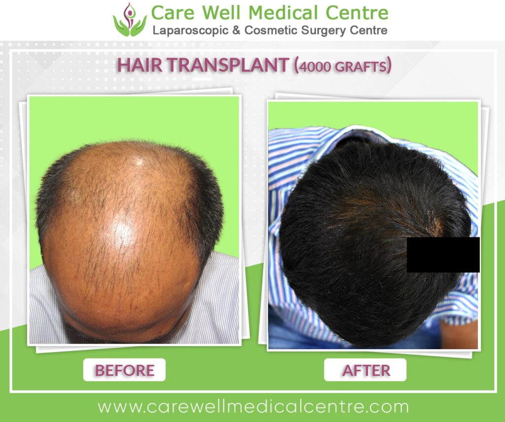 hair transplant before and after result photo 4000 graft 