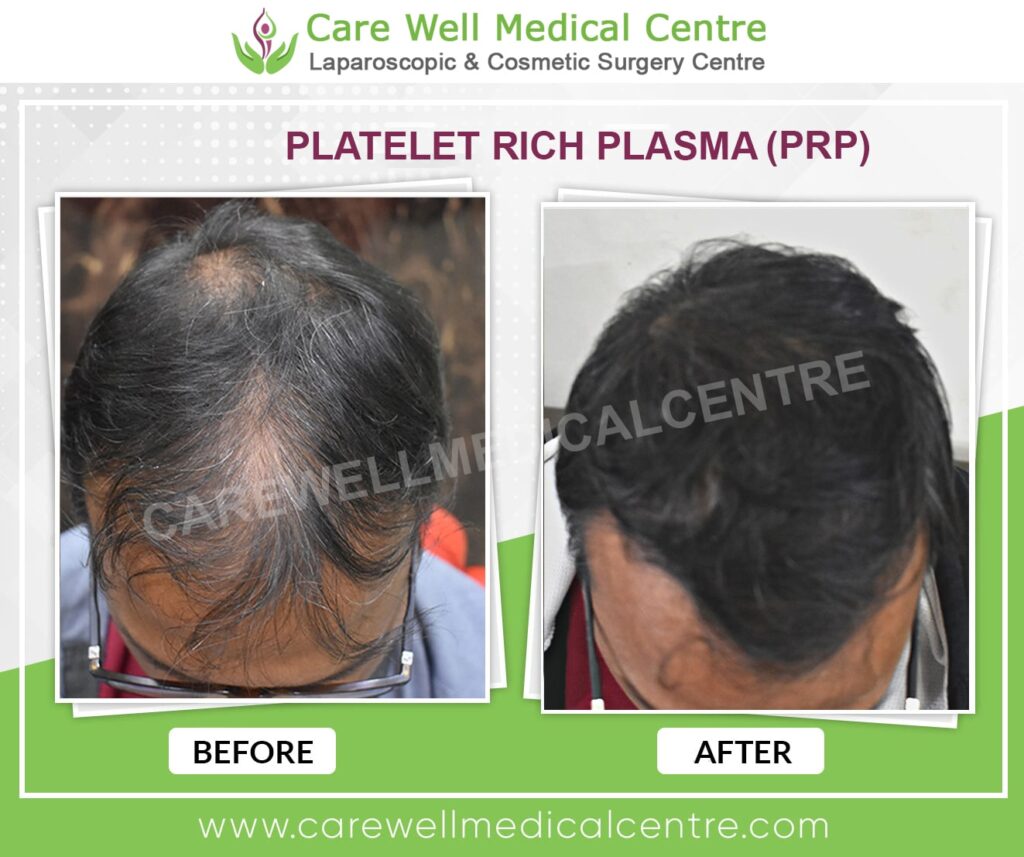 PRP Treatment in Delhi Before and After Result Photo
