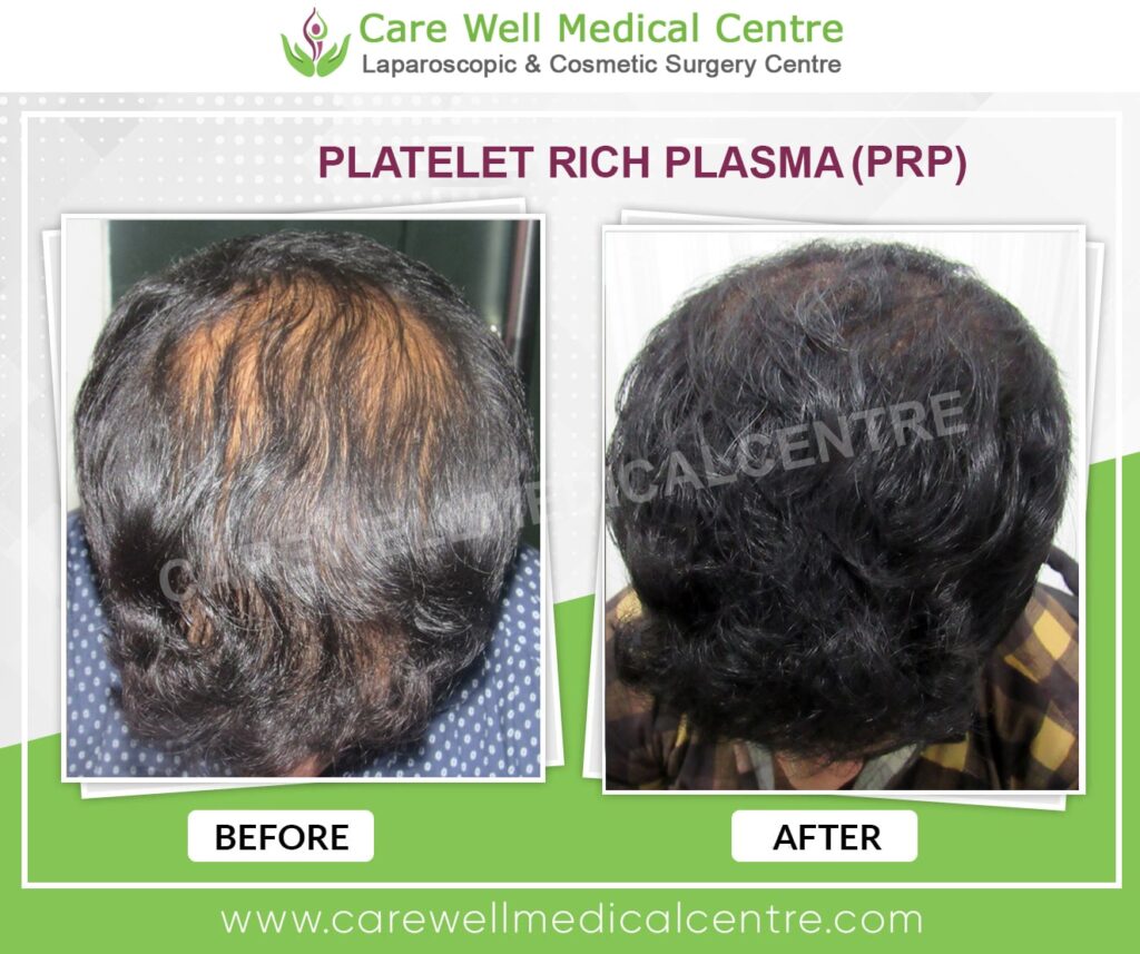PRP Treatment in Delhi Before and After Results Photos