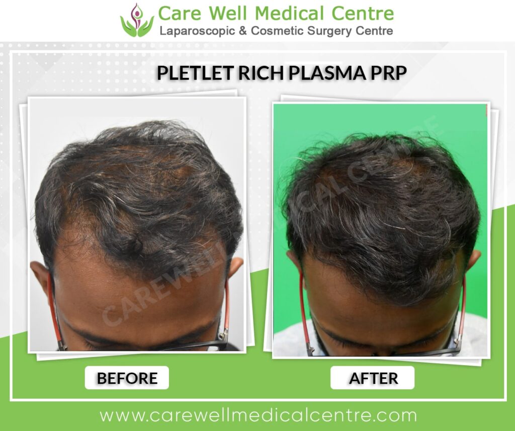 PRP Treatment in Delhi Before and After Result Photo