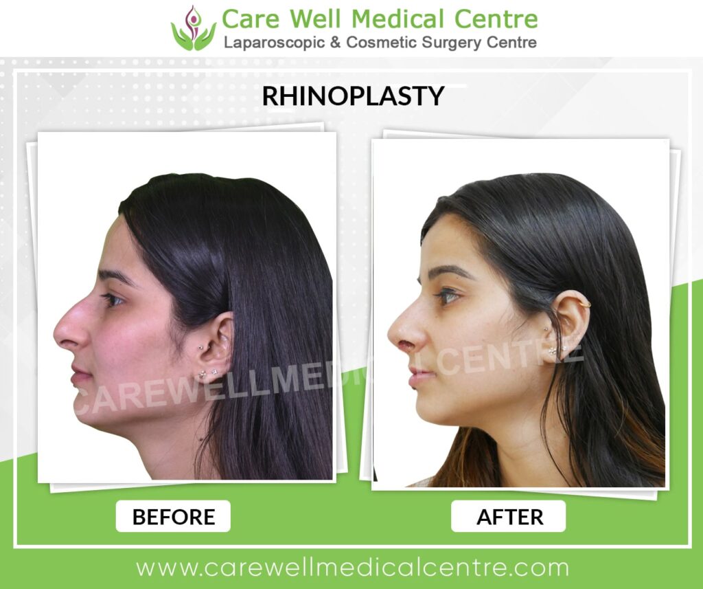 rhinoplasty surgery before and after photo