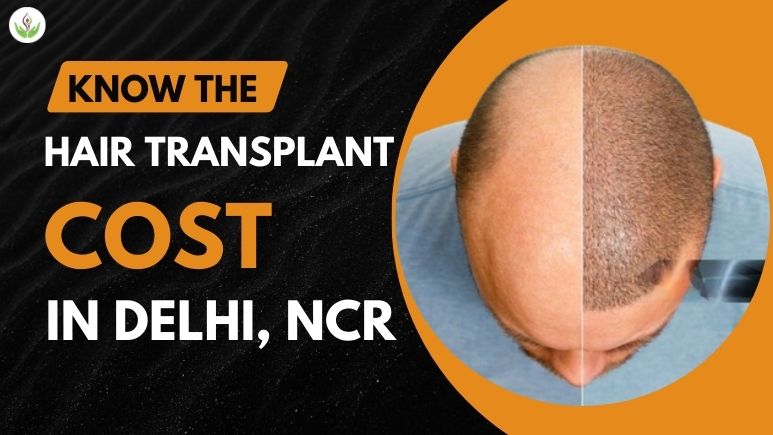cost of hair transplant in delhi ncr