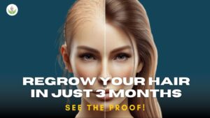 3-Month Alopecia Treatment Results by Dr. Sandeep Bhasin